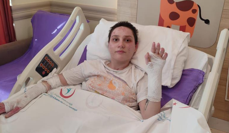 Kafe yangınında ağır yaralanan genç kız; Son 2 ayı hatırlamıyorum